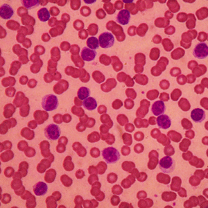 CLL cells